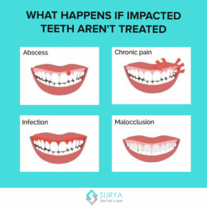 Wisdom Teeth Food Timeline: A Comprehensive Guide for a Smooth Recovery